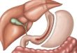 Laparoskopik Tüp Mide (Sleeve Gastrectomy) Ameliyatı